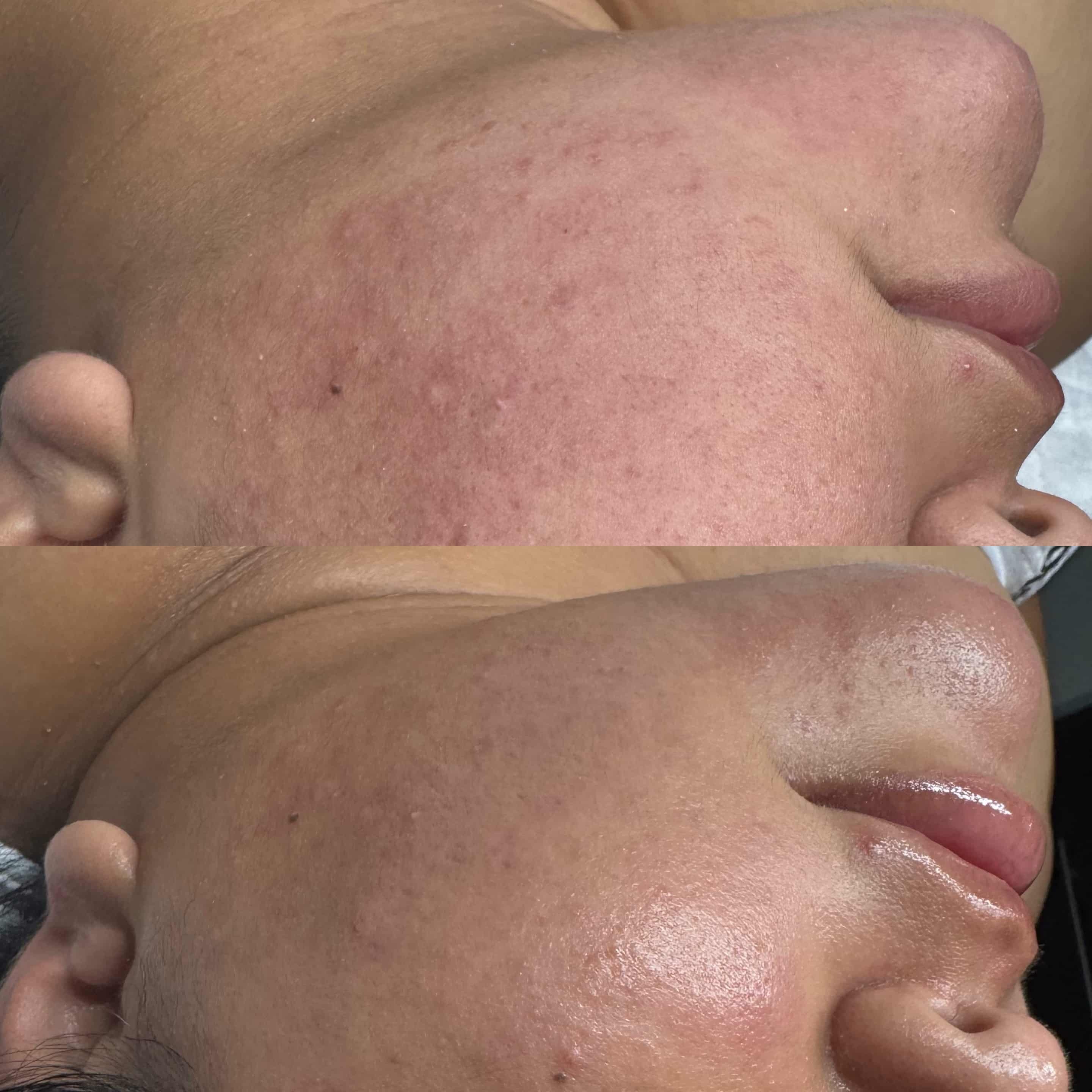 Cryo + LED Therapy | Euless, TX | Beauty Sanctuary